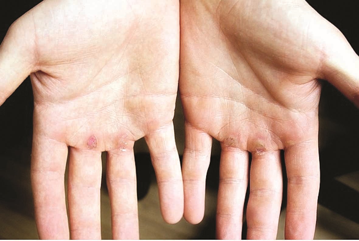 يدا لاعب رياضة تجديف مصابتين بالكالّو