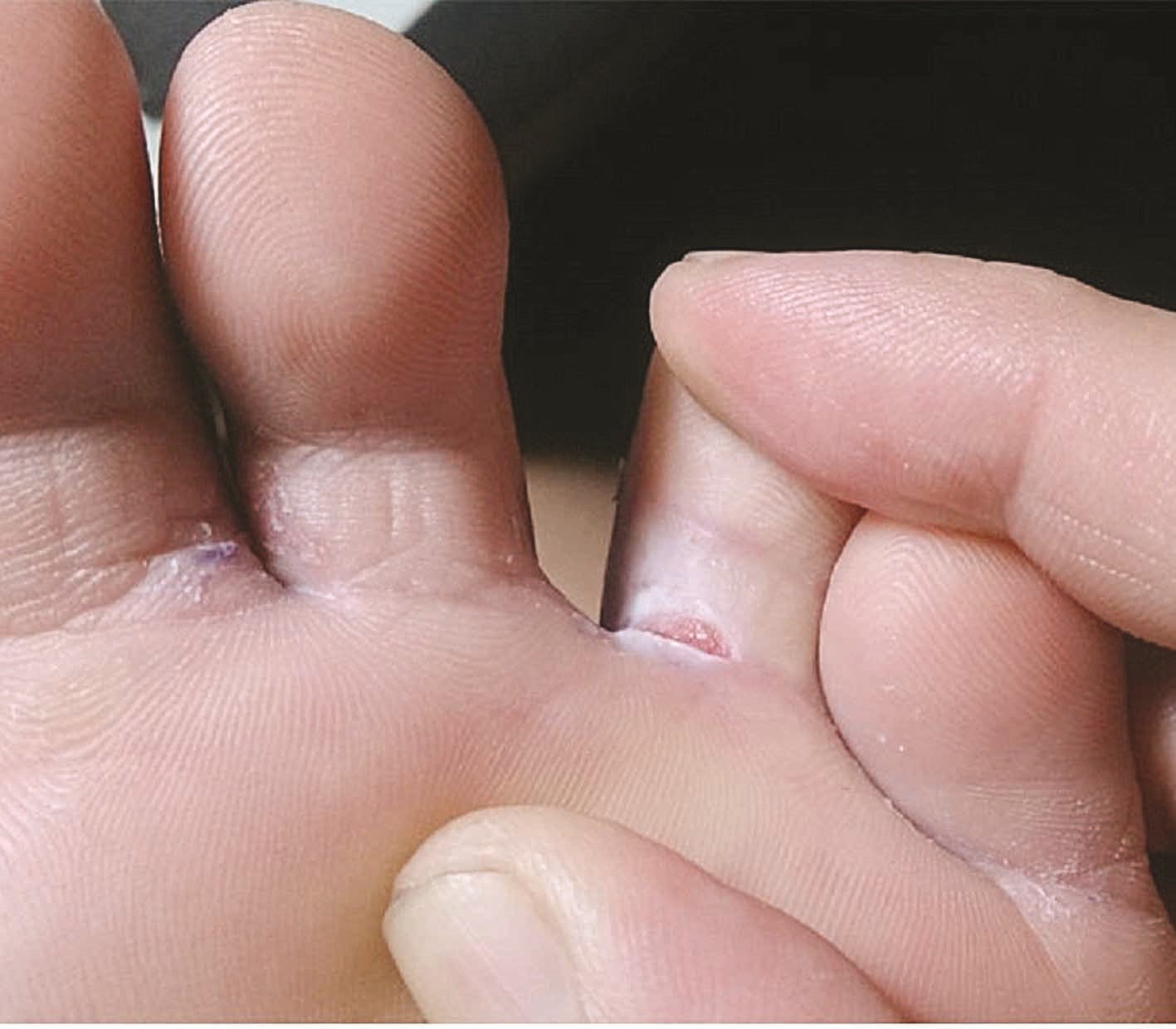 فطريات قدم الرياضي