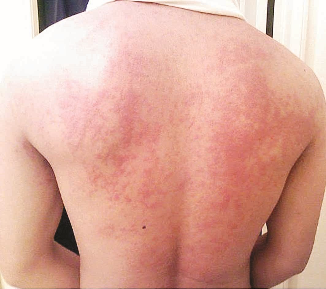 إرتيكاريا مائية