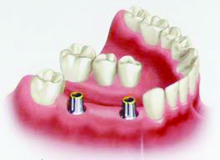 خطوات الزرع