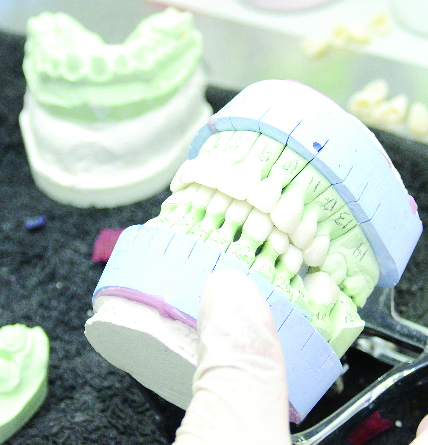 تكلفة زراعة الأسنان تختلف من حالة إلى أخرى