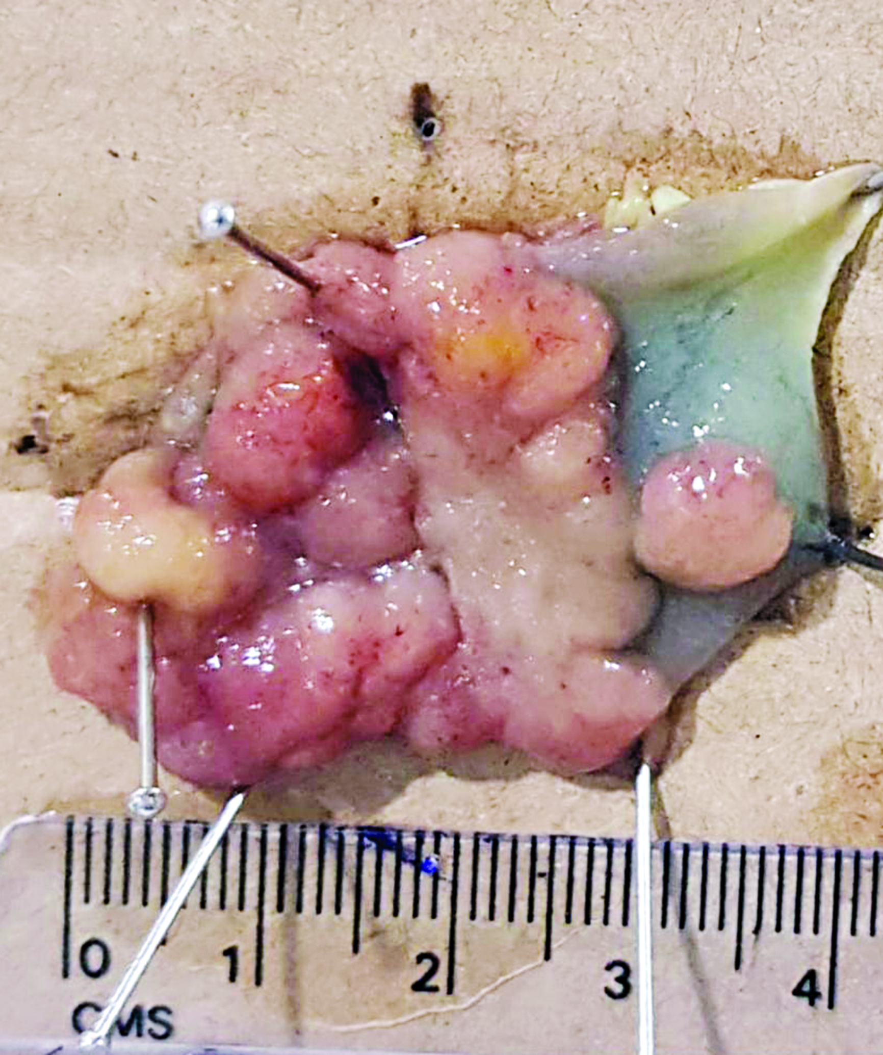 ورم في المعدة بعد استئصاله 