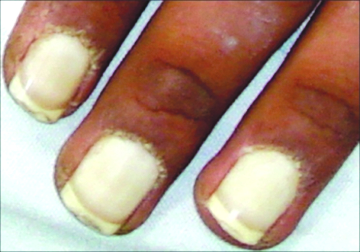 الابيضاض والشحوب