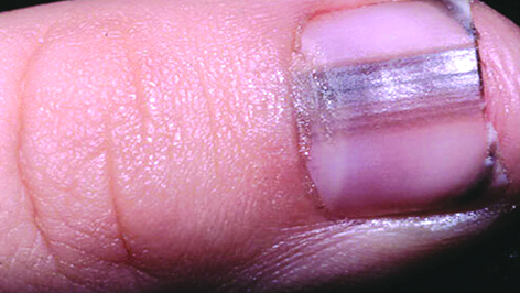 الأشرطة الداكنة