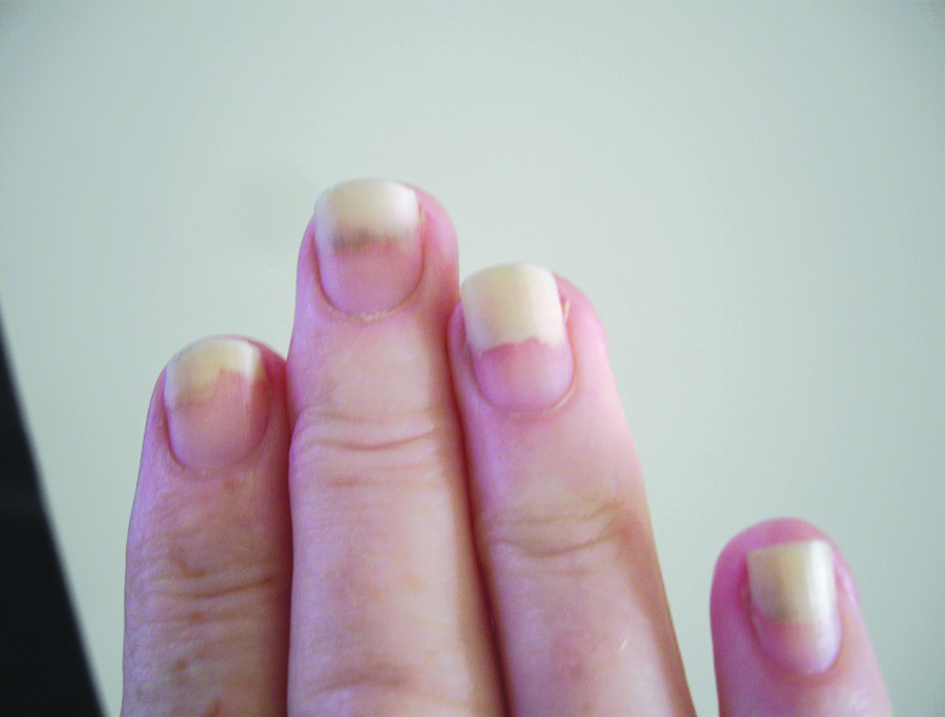 الانفصال عن الجلد