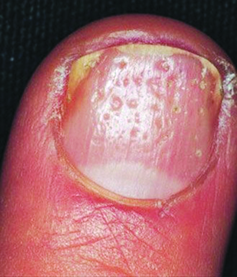 النُقَر الغائرة