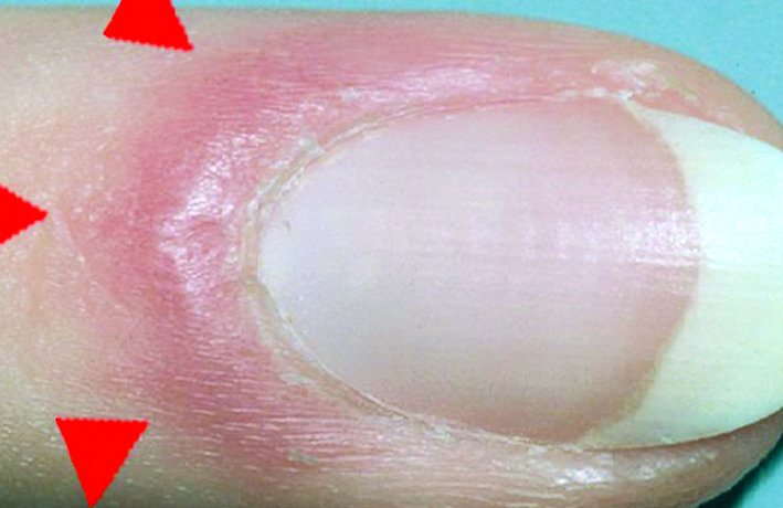 الانتفاخ المحيطي