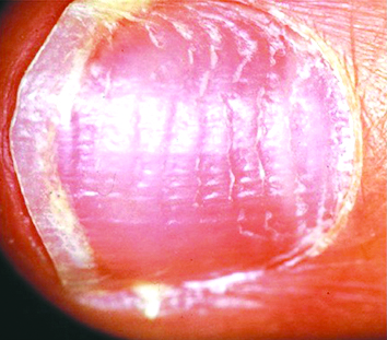 الأخاديد العرضية