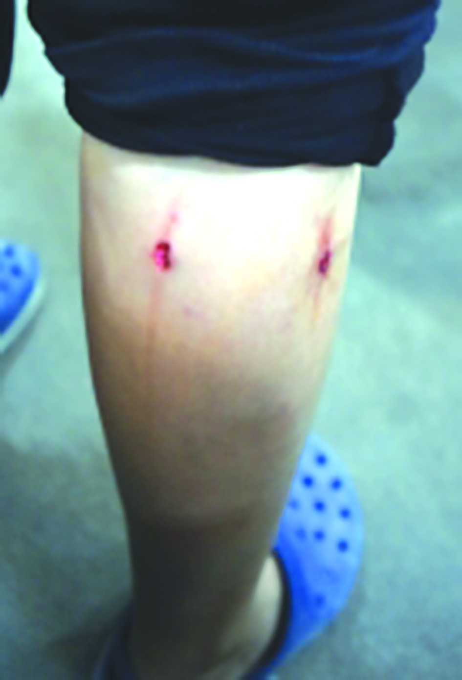 u0622u062bu0627u0631 u0627u0644u0639u0636 u0639u0644u0649 u0633u0627u0642  u062du0633u0627u0645t ( u062au0635u0648u064au0631 u0623u0633u0639u062f u0639u0628u062fu0627u0644u0644u0647)