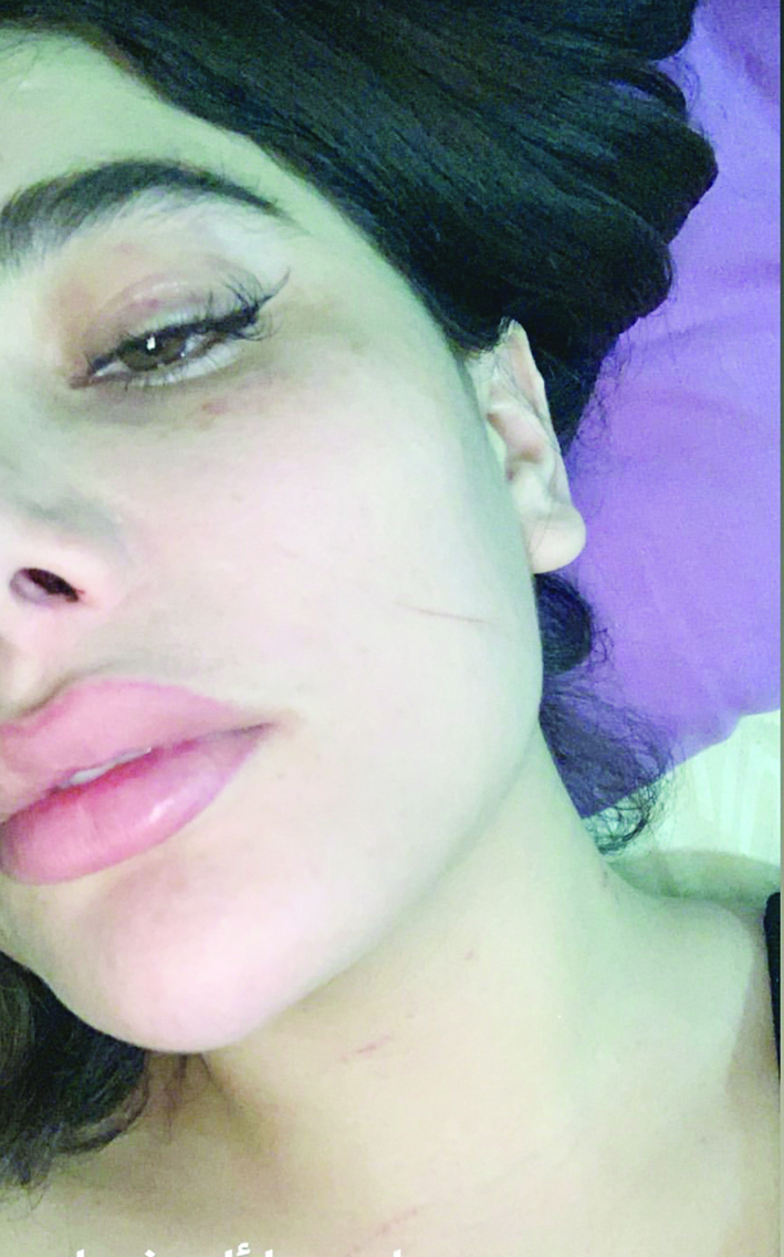 ... وتوضح آثار الضرب على وجهها 