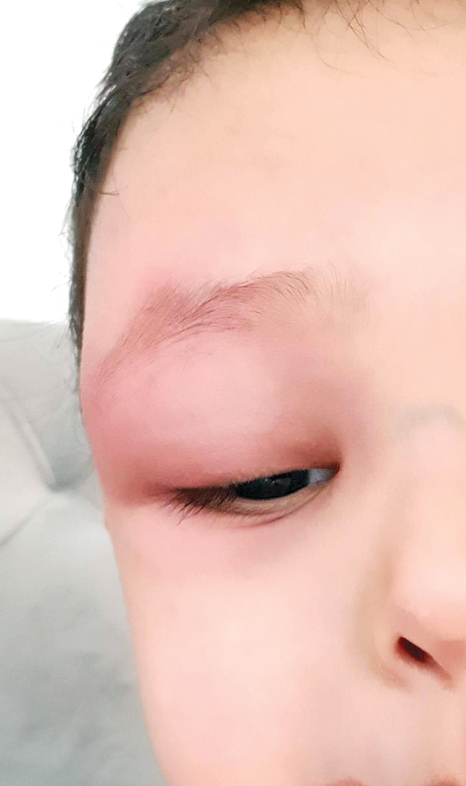 آثار المياه الملوّثة على عين أحد الأطفال