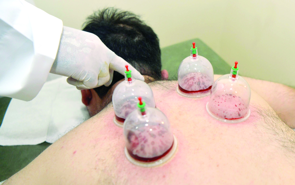 الحجامة... عملية جراحية مصغرة (أرشيف - «الراي»)