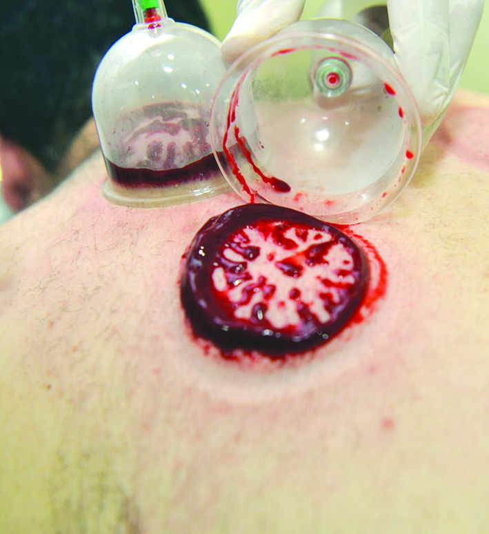 ضرورة اتباع الطرق العلمية في الحجامة 