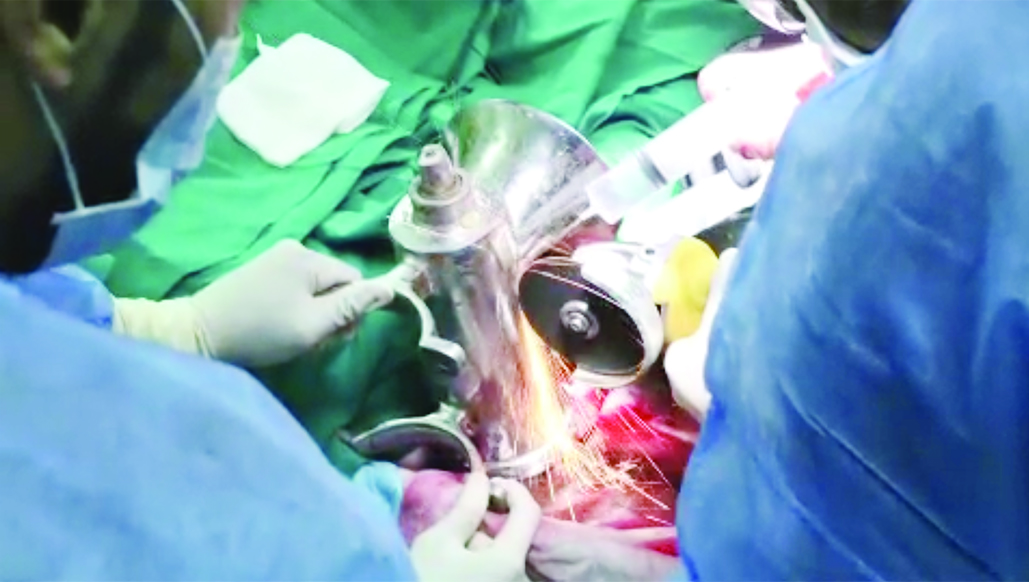 فرّامة اللحم بعد تخليص اليد منها