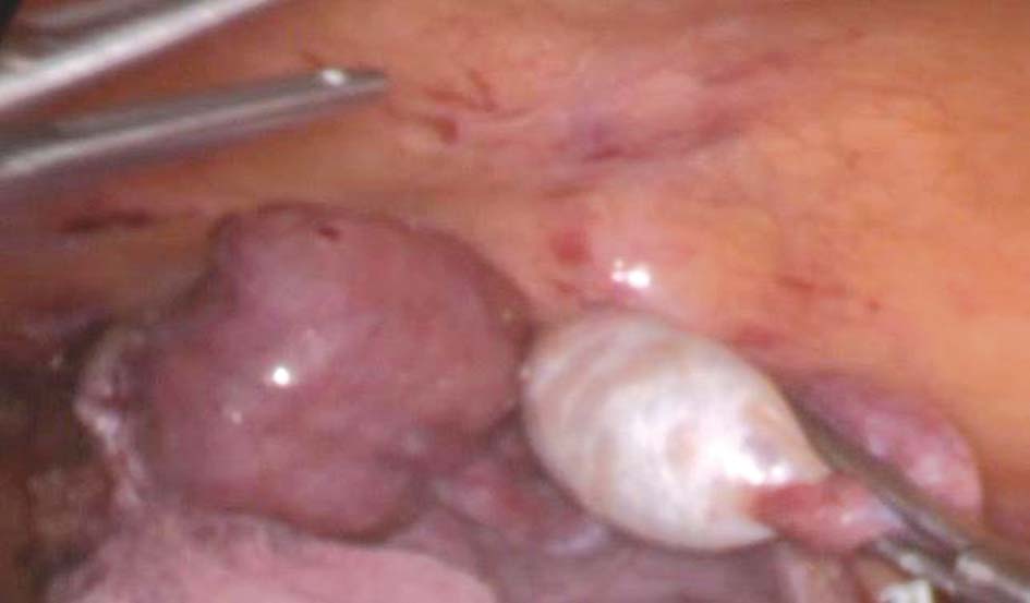 u0627u0644u062eu0635u064au0629 u0627u0644u0645u0639u0644u0642u0629 u0641u064a u062au062cu0648u064au0641 u0627u0644u0628u0637u0646 u0627u0644u062au064a u062au0645 u0627u0633u062au0626u0635u0627u0644u0647u0627 