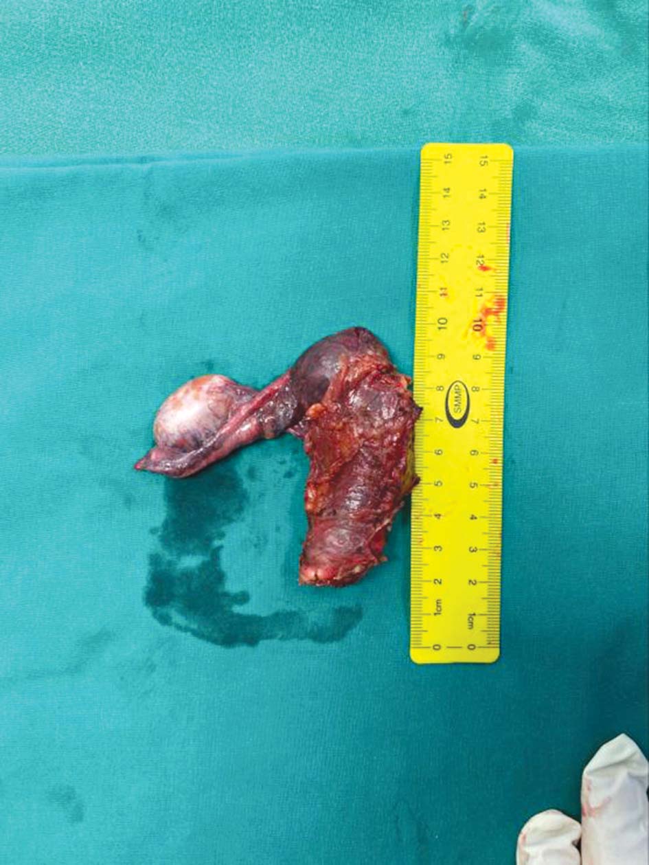 الرحم المستأصل