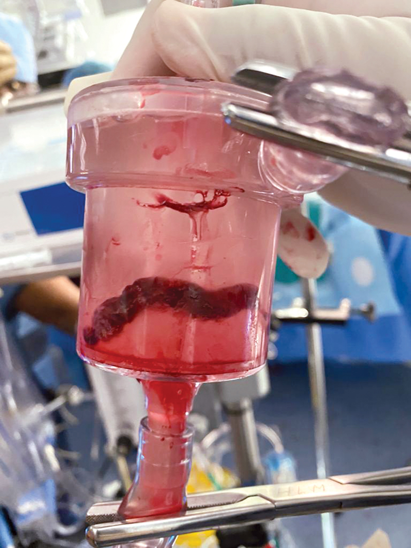 الجلطة الأولي بعد استئصالها