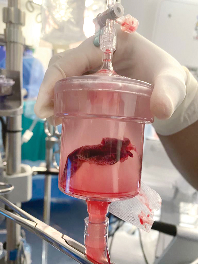 الجلطة الثانية 