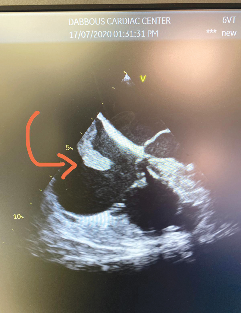 الجلطتان في القلب عبر الأشعة 