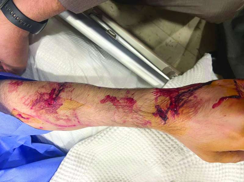 ... وآثار العض على يده