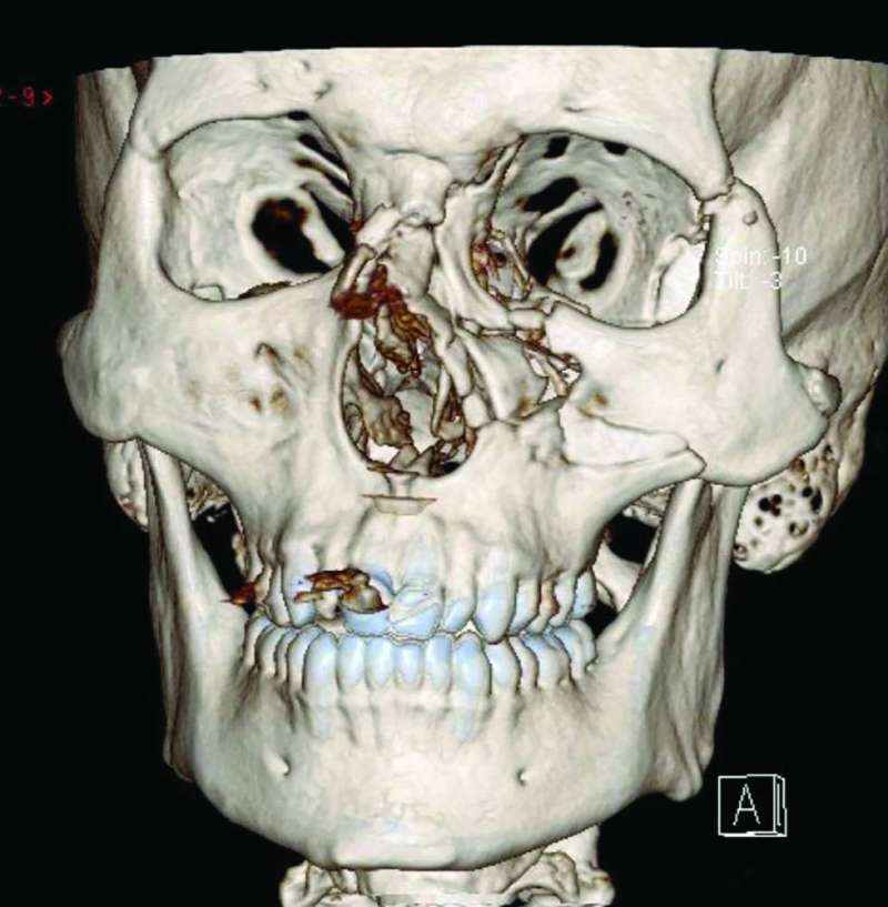 التشخيص الخاطئ والتأخّر في علاج كسور الوجه يُؤدّيان إلى مضاعفات خطيرة