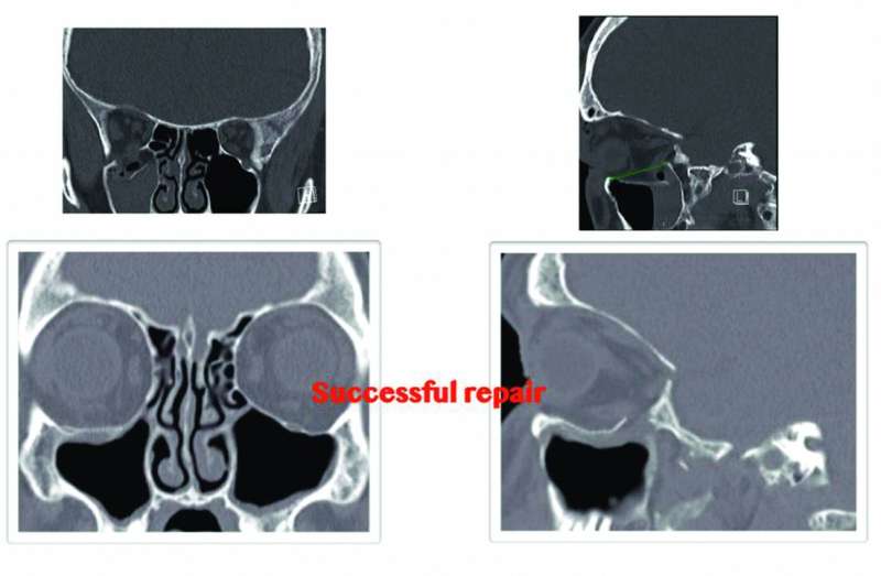 إصلاح كسور قاع العين باستخدام جراحات مناظير الجيوب الأنفية هي تقنية جراحية تجميلية جديدة
