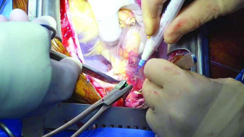 جانب من إجراء عملية زراعة القلب