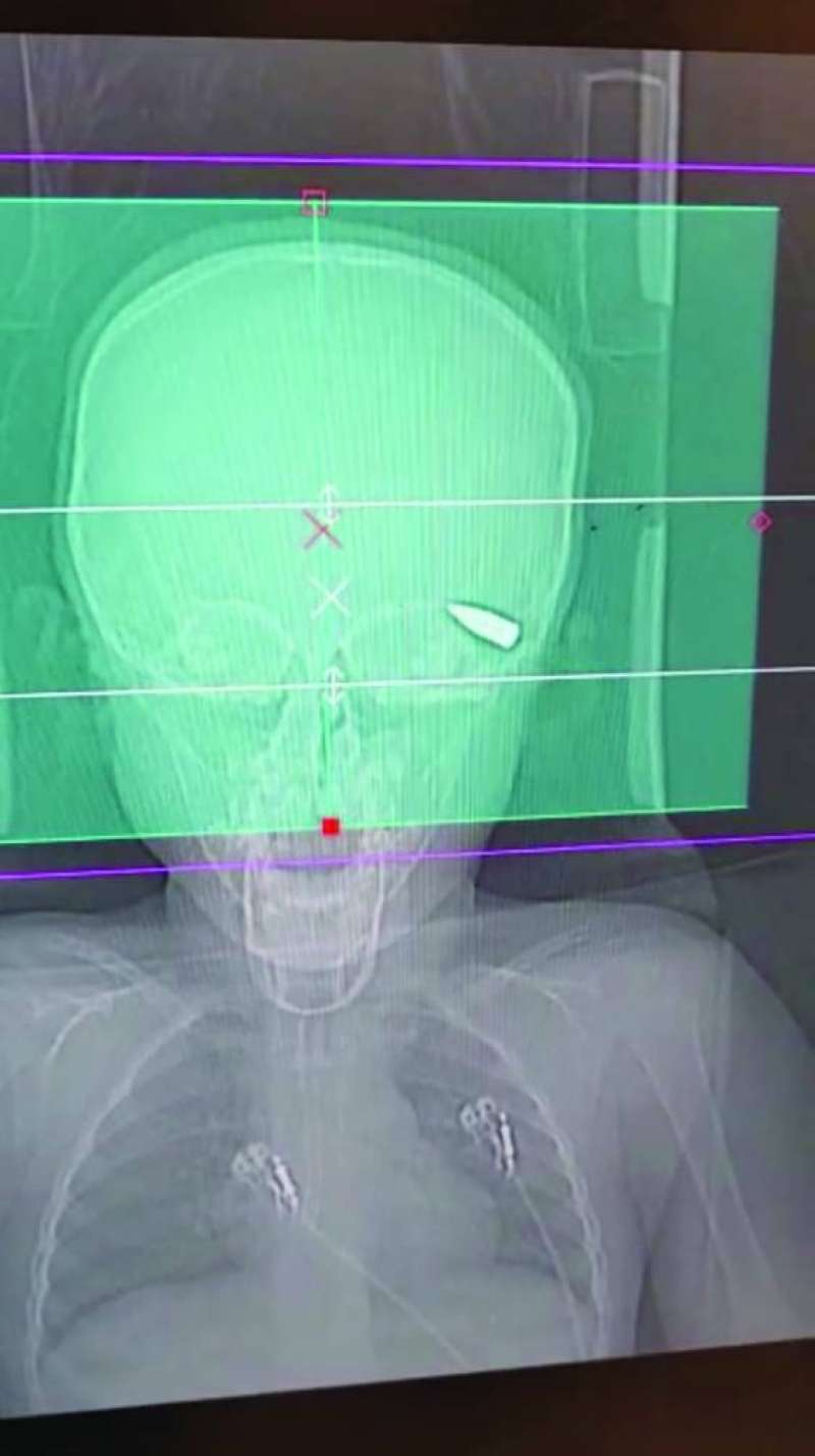 الطلقة مستقرة في قعر الجمجمة 
