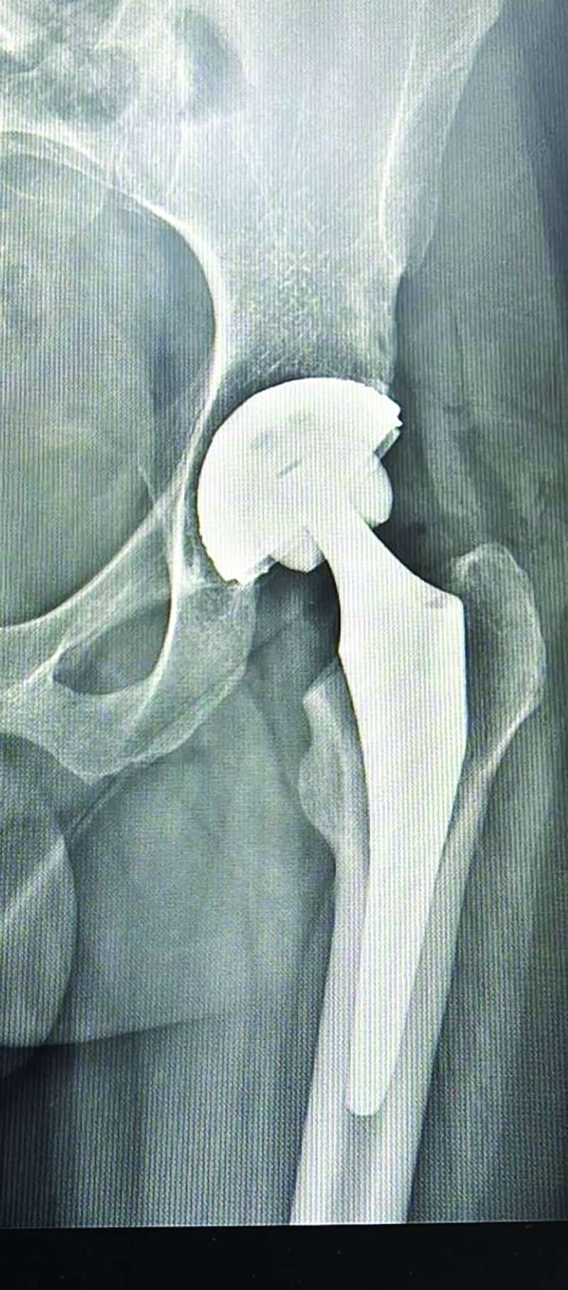 بعد تركيب المفصل