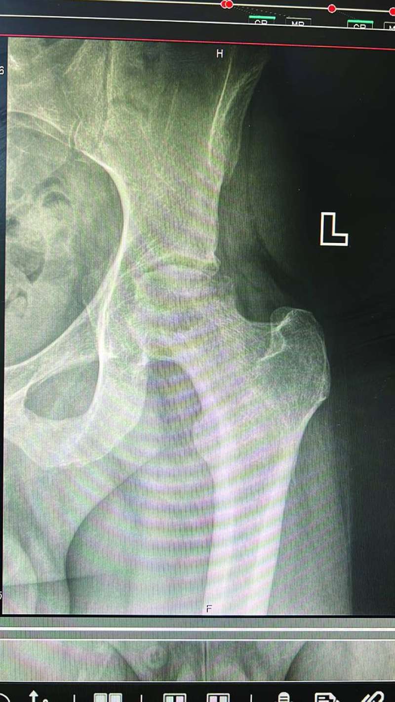 حالة المفصل كما تبدو بالأشعة