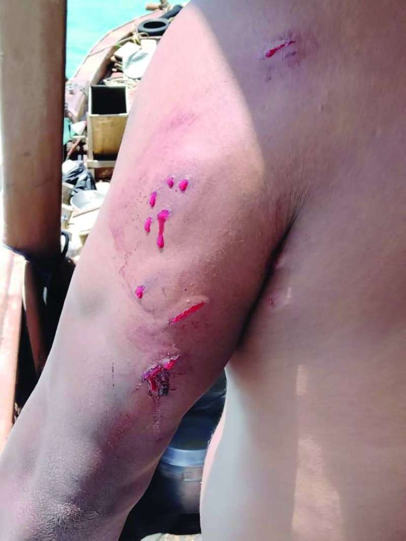 
أحد الصيادين يتعرض لإصابات من السلابة