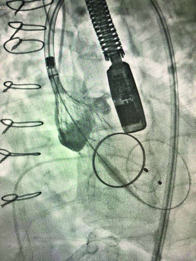 صور توضيحية تبيّن الإنجاز الطبي في الحالة الأولى