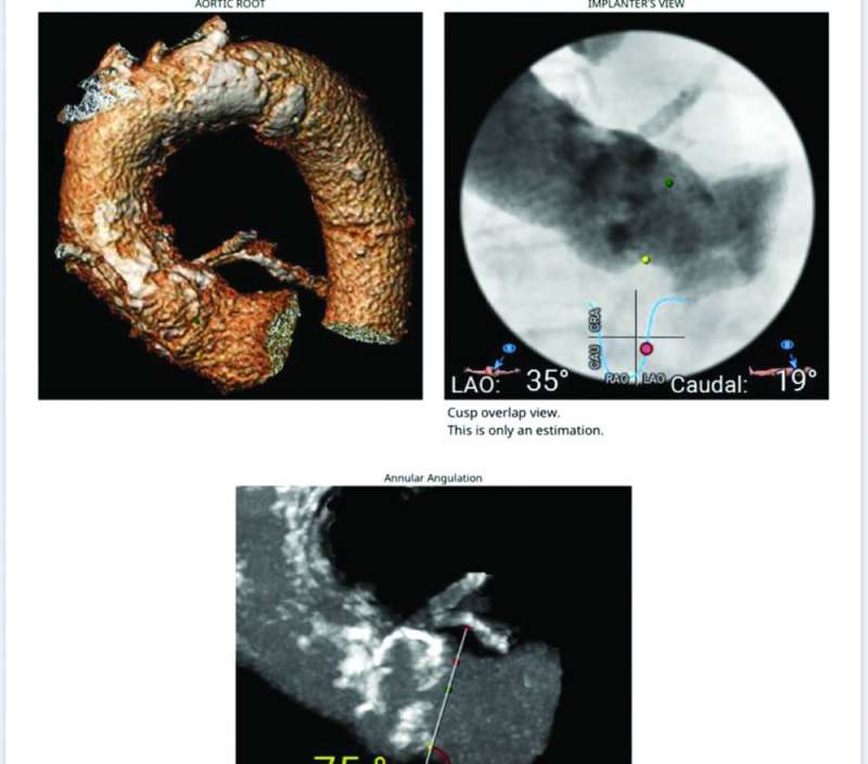 صور توضيحية تبيّن الإنجاز الطبي في الحالة الثانية 