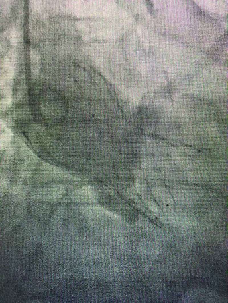 صور توضيحية تبيّن الإنجاز الطبي في الحالة الثانية