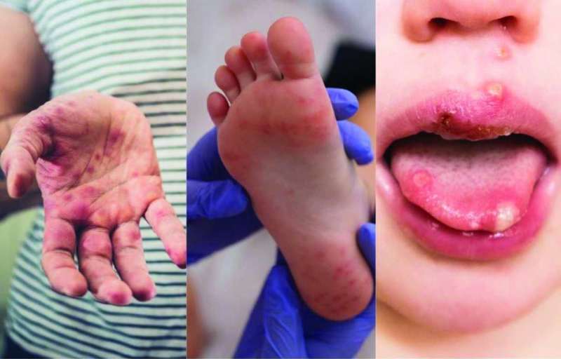 آثار الفيروس على الفم واليد والرجل 
