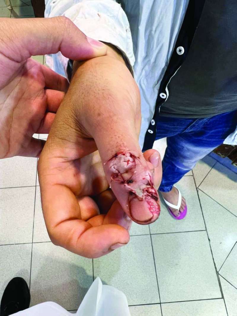 


جرح ظاهر في يد عامل 