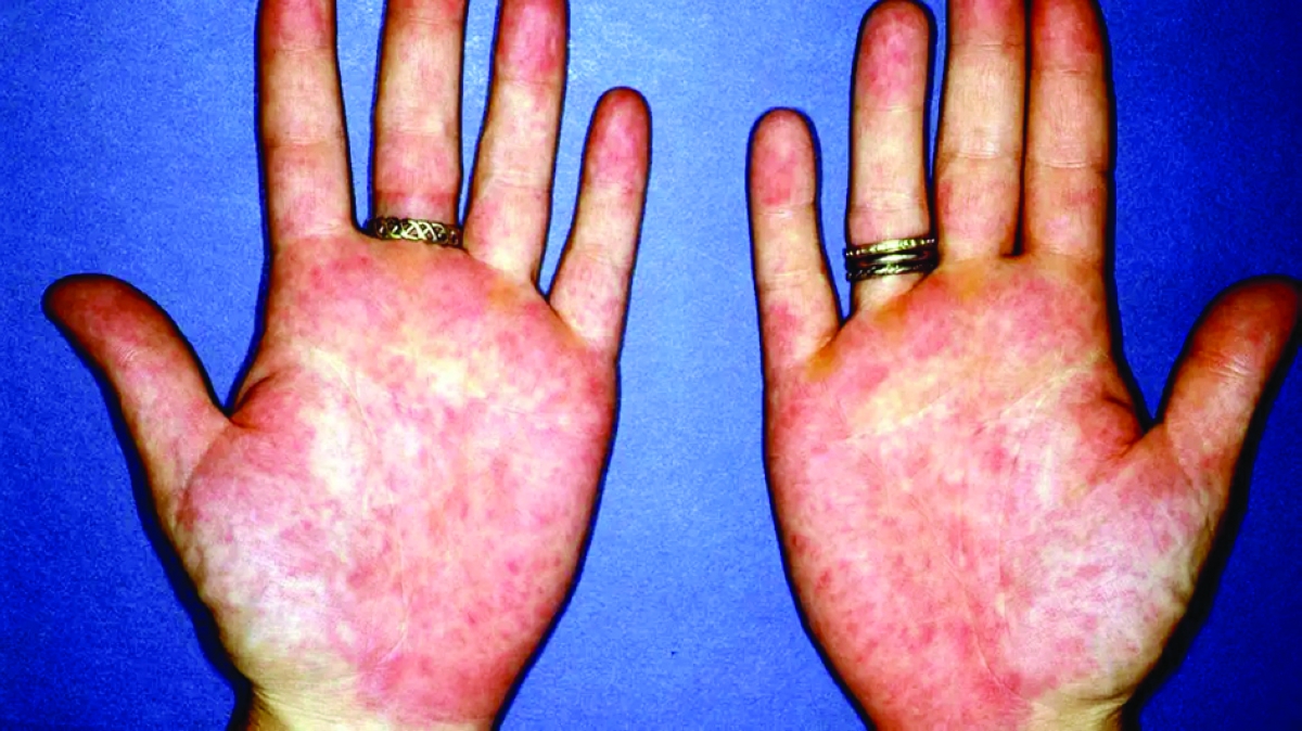 تغير لون راحة اليد إلى اللون الأحمر من الأعراض