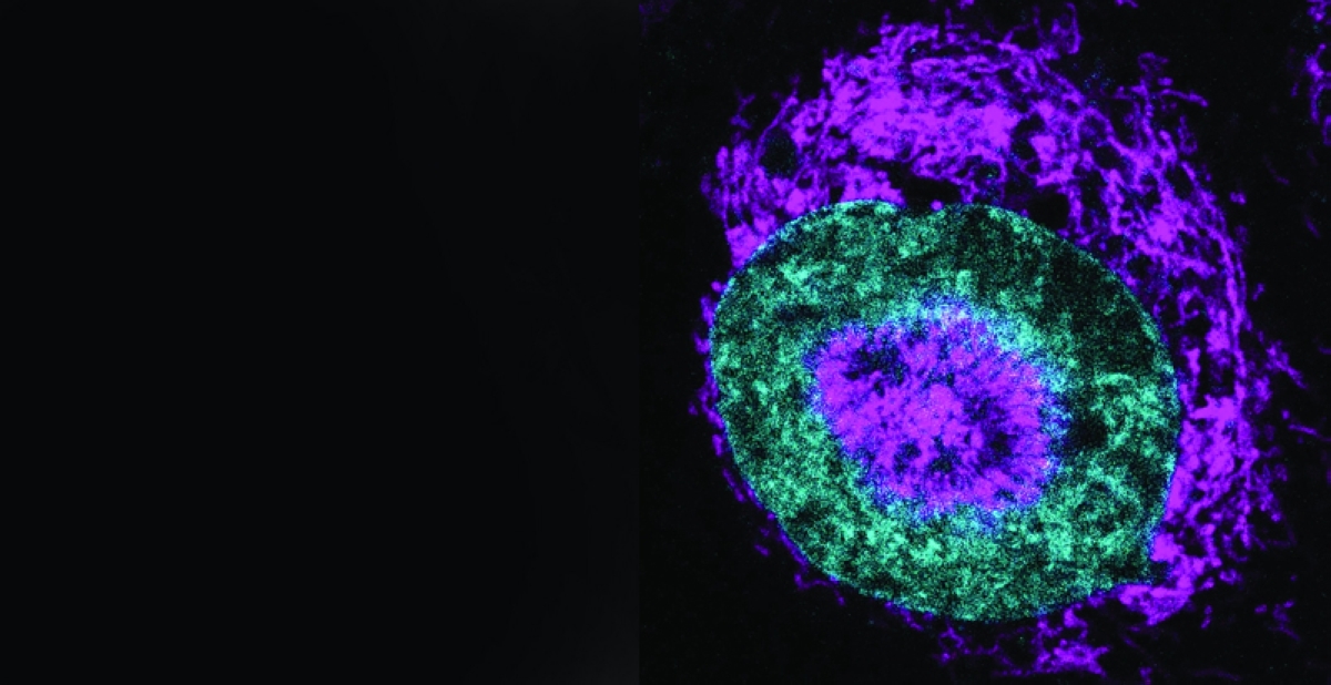 خلية سرطانية محصورة حيث يمكن رؤية الميتوكوندريا (باللون الأرجواني) تتراكم على محيط النواة 