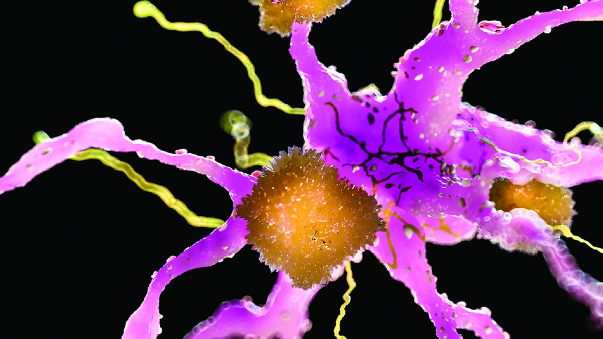 تراكمات البروتين المعيبة مرتبطة بمرض ألزهايمر 