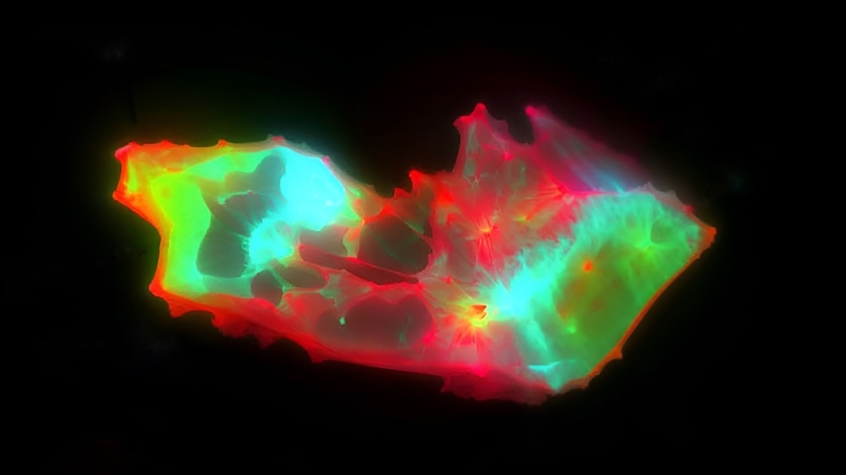 صورة مجهرية لجلطة دموية صغيرة موجودة في دم مريض مصاب بـ«كوفيد طويل الأمد»