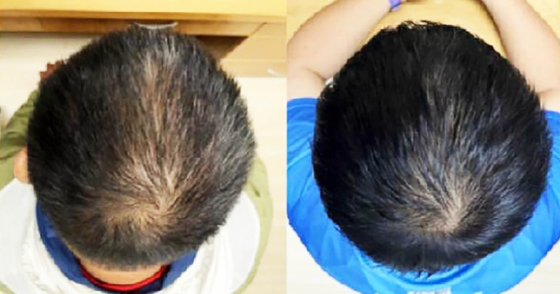 ابتكار مصل نباتي يعيد إنبات الشعر في غضون أسابيع 