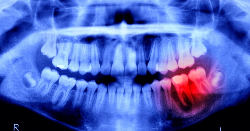 البشر قد يتمكنون من إنبات أسنان بديلة 