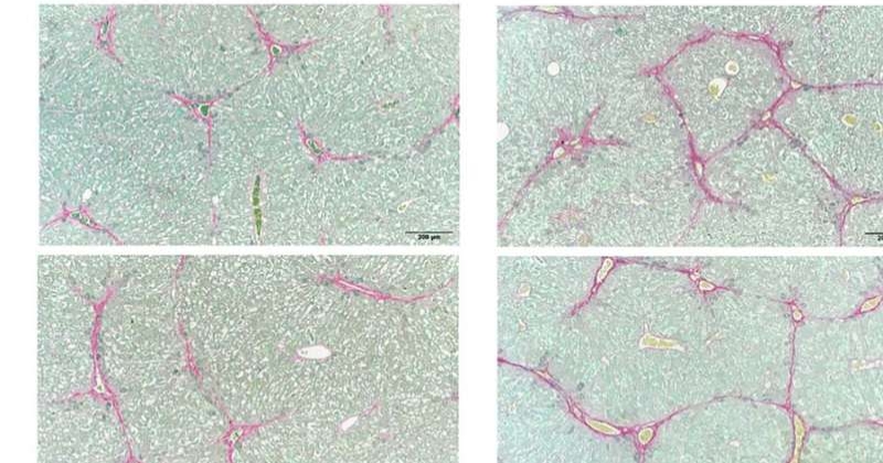 بكتيريا الفم تنتقل .... إلى أمعاء مرضى الكبد 