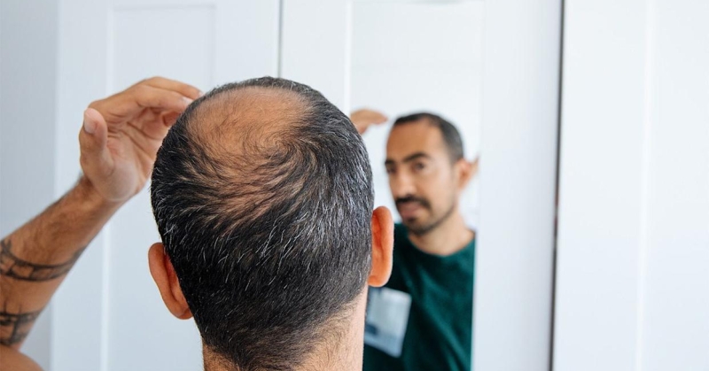 ما علاجات تساقط الشعر الأكثر فعالية؟ 