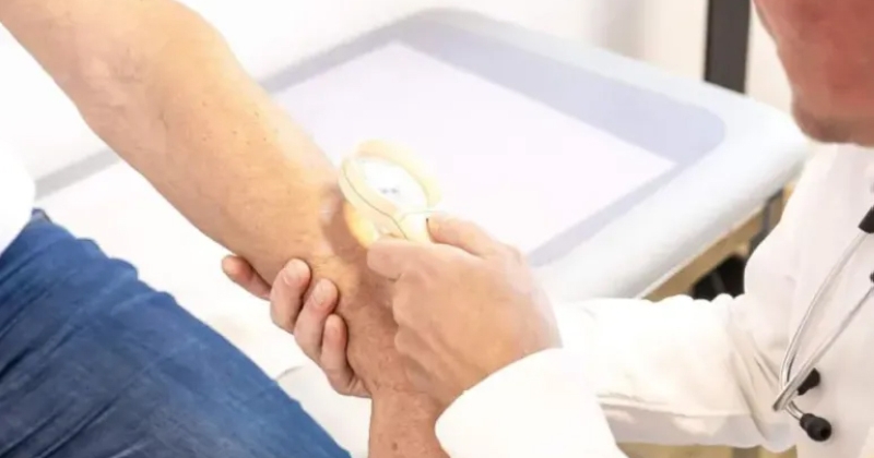 بروتين خفي يقود سرطان الجلد ويعطل المناعة.. دراسة تكشف