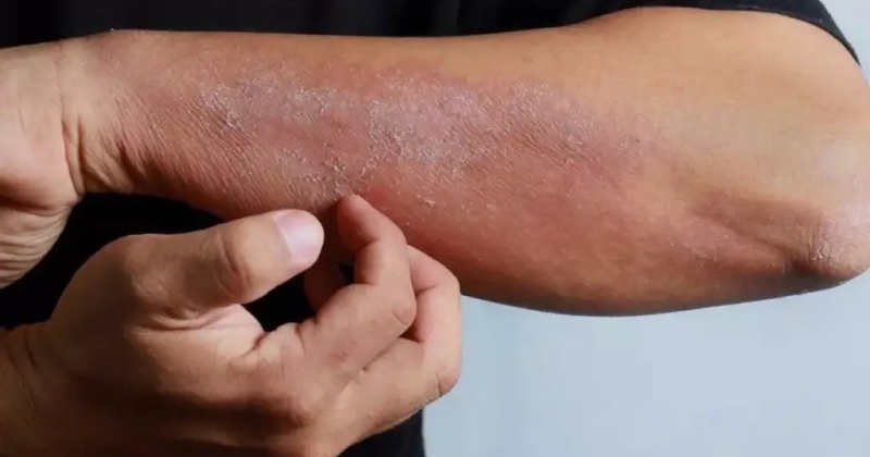 ابتكار بروتوكول غذائي لمعالجة الإكزيما... خلال 30 يوماً 